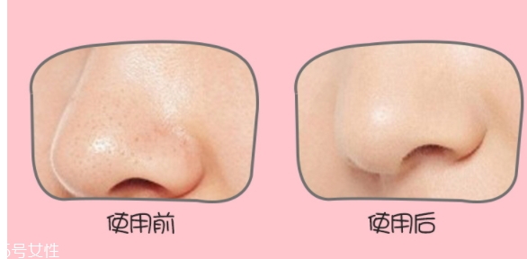 yoii黑頭儀怎么用？yoii黑頭儀怎么充電