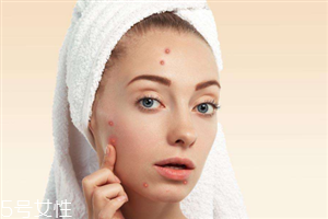 臉上為什么長(zhǎng)痘 長(zhǎng)痘痘的原因介紹 臉上為什么長(zhǎng)痘 長(zhǎng)痘痘的原因介紹