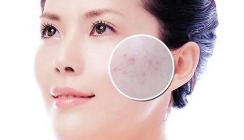 春天臉上長痘痘怎么辦 臉上長痘痘是什么原因 春天臉上長痘痘怎么辦 臉上長痘痘是什么原因