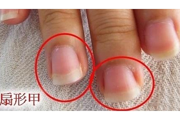 扇形甲怎么修復 扇形甲修復方法