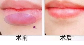 厚唇變薄術注意事項 厚唇變薄術術后護理 厚唇變薄術注意事項 厚唇變薄術術后護理