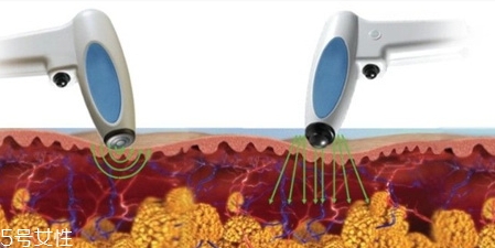 射頻溶脂是永久的嗎？射頻溶脂多久反彈