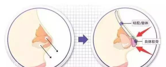 墊鼻尖需要多少錢 墊鼻尖手術(shù)價(jià)格高嗎 墊鼻尖需要多少錢 墊鼻尖手術(shù)價(jià)格高嗎