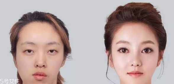 墊鼻尖需要多少錢 墊鼻尖手術(shù)價(jià)格高嗎 墊鼻尖需要多少錢 墊鼻尖手術(shù)價(jià)格高嗎