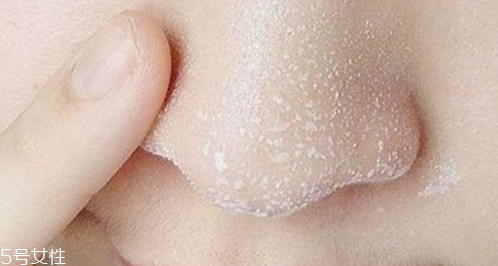 黑頭不管它會(huì)變大嗎？黑頭不管它會(huì)怎樣？