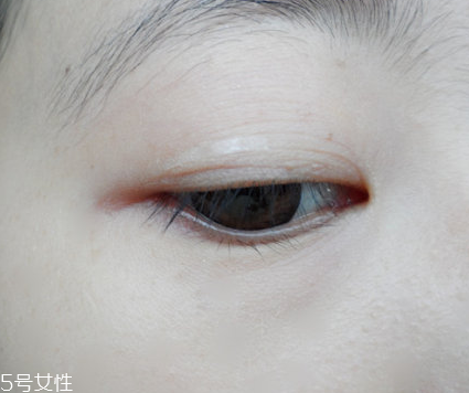 雙眼皮貼能定型嗎 因人而異 雙眼皮貼能定型嗎 因人而異