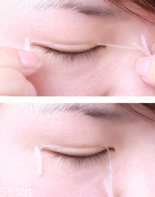 雙眼皮貼能定型嗎 因人而異 雙眼皮貼能定型嗎 因人而異