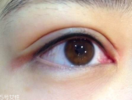 美瞳線一直流淚正常嗎 眼睛敏感的原因 美瞳線一直流淚正常嗎 眼睛敏感的原因