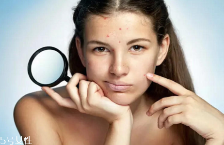 痘痘肌怎么改善 記住這5點(diǎn) 痘痘肌怎么改善 記住這5點(diǎn)