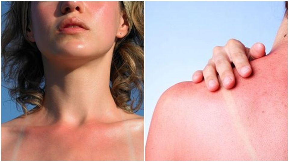 曬傷了怎么辦 3段式肌膚急救 曬傷了怎么辦 3段式肌膚急救