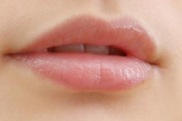 秋冬季嘴唇干裂脫皮怎么辦 秋冬季嘴唇干裂脫皮怎么辦