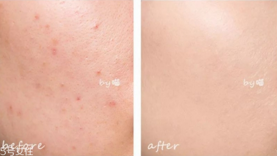 遮痘印用哪款遮瑕最好 遮痘印化妝方法 遮痘印用哪款遮瑕最好 遮痘印化妝方法