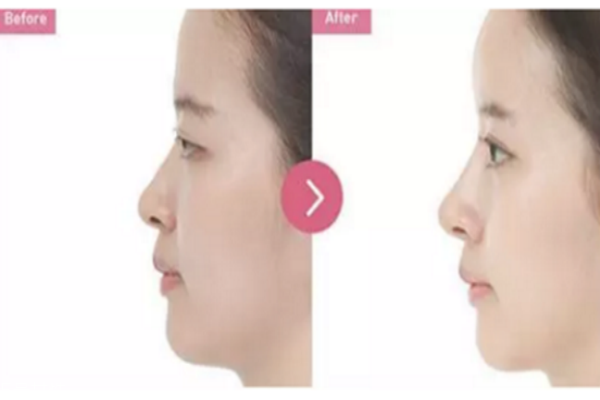 除皺針與玻尿酸哪個更好 除皺針和玻尿酸的區(qū)別 除皺針與玻尿酸哪個更好 除皺針和玻尿酸的區(qū)別