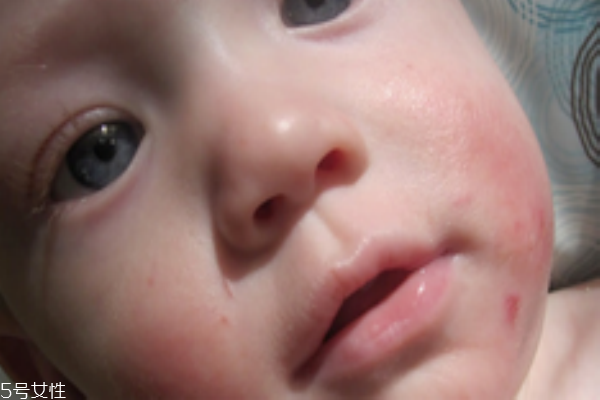 剛出生的寶寶臉上長(zhǎng)濕疹怎么辦 剛出生的寶寶臉上長(zhǎng)濕疹怎么辦