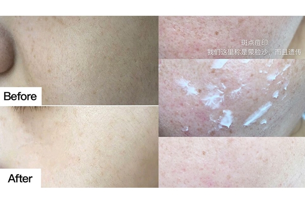 祛斑膏哪個牌子好 爆款祛斑膏推薦 祛斑膏哪個牌子好 爆款祛斑膏推薦