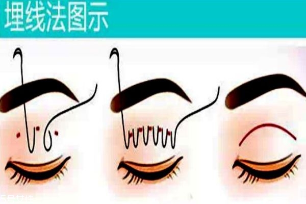 韓式三點和埋線的區(qū)別 你適合做什么樣的 韓式三點和埋線的區(qū)別 你適合做什么樣的