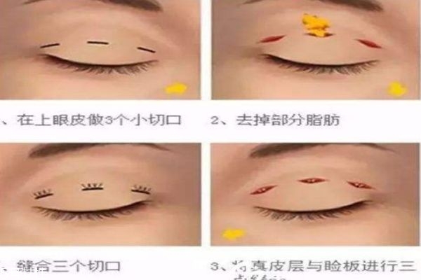 韓式三點和埋線的區(qū)別 你適合做什么樣的 韓式三點和埋線的區(qū)別 你適合做什么樣的