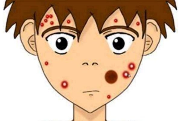 快速祛痘的方法有哪些 快速祛痘小妙招 快速祛痘的方法有哪些 快速祛痘小妙招