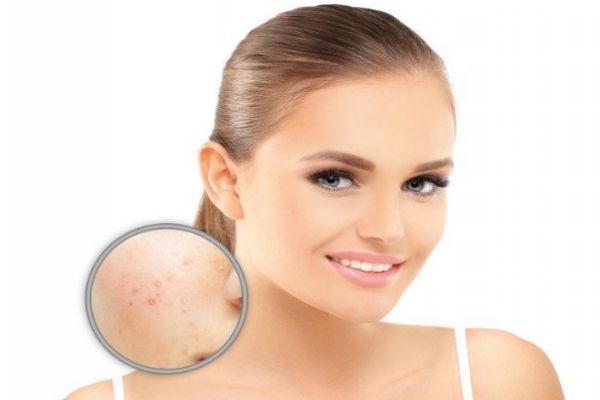 臉上長膿痘能擠嗎 痘痘有膿可以擠掉嗎 臉上長膿痘能擠嗎 痘痘有膿可以擠掉嗎