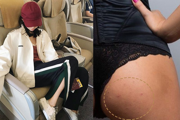 屁股長痘痘怎么辦 簡單4招跟著做 屁股長痘痘怎么辦 簡單4招跟著做