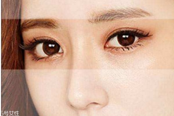 韓式三點(diǎn)雙眼皮與全切雙眼皮有什么不同 各有優(yōu)缺點(diǎn) 韓式三點(diǎn)雙眼皮與全切雙眼皮有什么不同 各有優(yōu)缺點(diǎn)