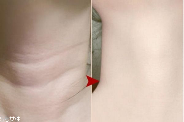 如何去掉頸紋 解決頸紋的小竅門 如何去掉頸紋 解決頸紋的小竅門