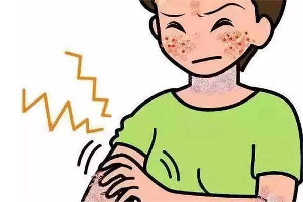 缺脂性皮炎癥狀與保養(yǎng)治療 缺脂性皮炎癥狀與保養(yǎng)治療