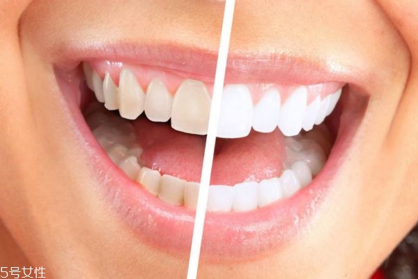 冷光美白牙齒好不好 冷光美白儀副作用 冷光美白牙齒好不好 冷光美白儀副作用