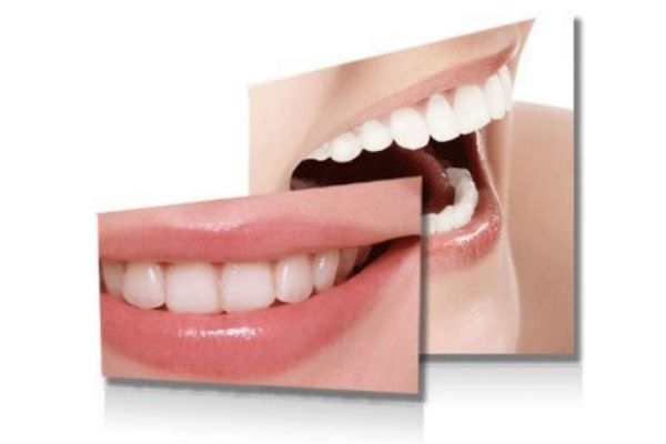 冷光美白牙齒好不好 冷光美白儀副作用 冷光美白牙齒好不好 冷光美白儀副作用