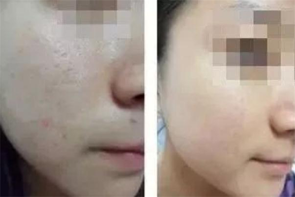 意大利三文魚水光針成分 三文魚水光針安全嗎 意大利三文魚水光針成分 三文魚水光針安全嗎