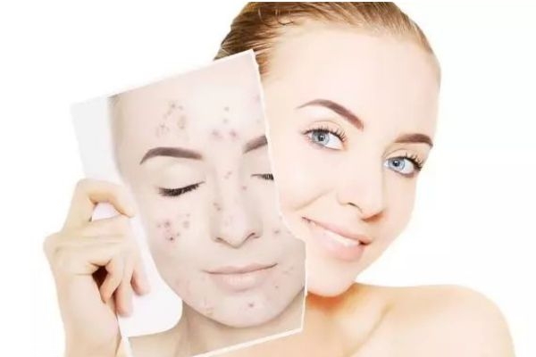 長痘期的需要用什么護(hù)膚品 長痘不要用什么護(hù)膚品 長痘期的需要用什么護(hù)膚品 長痘不要用什么護(hù)膚品