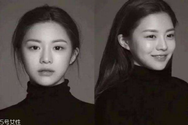 激光去痘印后會反黑嗎 激光去痘印術(shù)后反黑原因 激光去痘印后會反黑嗎 激光去痘印術(shù)后反黑原因