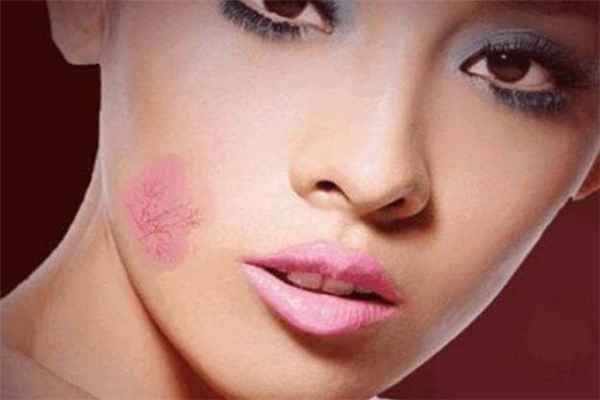 激光祛紅血絲疼嗎 激光去紅血絲什么感覺 激光祛紅血絲疼嗎 激光去紅血絲什么感覺