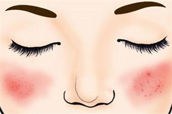 激光祛紅血絲疼嗎 激光去紅血絲什么感覺 激光祛紅血絲疼嗎 激光去紅血絲什么感覺