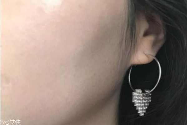 水光針能收縮毛孔嗎 水光針打完多久起效果 水光針能收縮毛孔嗎 水光針打完多久起效果