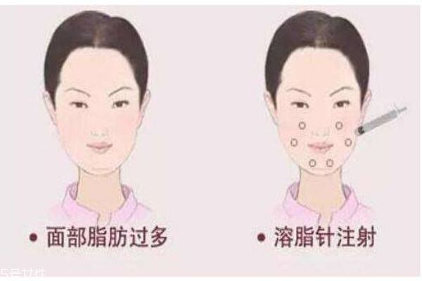 溶脂針的原理是什么呢 打完溶脂針有什么注意事項(xiàng)嗎 溶脂針的原理是什么呢 打完溶脂針有什么注意事項(xiàng)嗎