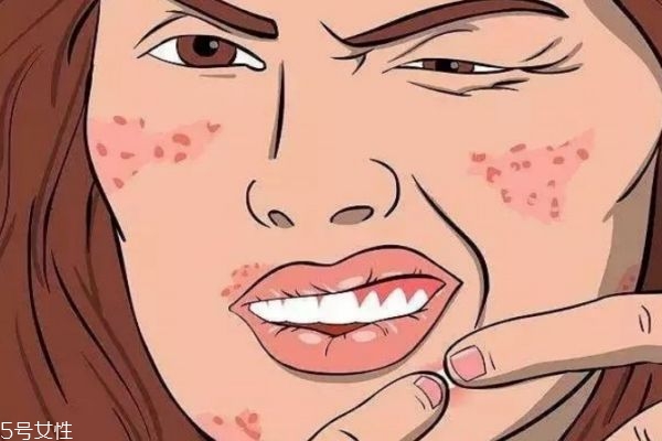 心情會對痘痘有影響嗎 長痘痘的內(nèi)因有什么呢 心情會對痘痘有影響嗎 長痘痘的內(nèi)因有什么呢