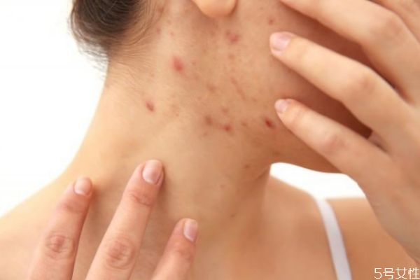 脖子上為什么會長痘 脖子上長痘痘什么原因 脖子上為什么會長痘 脖子上長痘痘什么原因