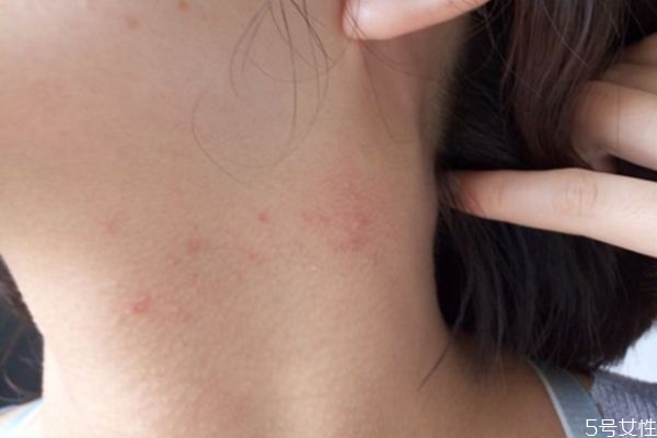 脖子上長(zhǎng)痘痘很痛怎么辦 脖子上長(zhǎng)痘痘怎么調(diào)理 脖子上長(zhǎng)痘痘很痛怎么辦 脖子上長(zhǎng)痘痘怎么調(diào)理