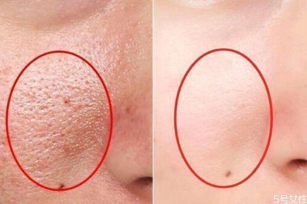 臉上的毛孔為什么會變大 毛孔為什么會變粗 臉上的毛孔為什么會變大 毛孔為什么會變粗