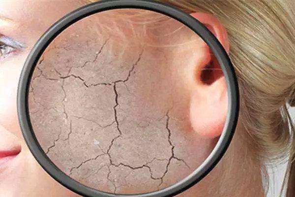 冬天臉紅發(fā)燙怎么辦 什么皮膚冬天更容易臉紅發(fā)燙 冬天臉紅發(fā)燙怎么辦 什么皮膚冬天更容易臉紅發(fā)燙