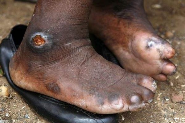 什么是麻風(fēng)病呢 麻風(fēng)病有實(shí)名癥狀呢 什么是麻風(fēng)病呢 麻風(fēng)病有實(shí)名癥狀呢