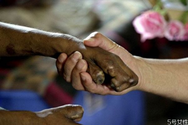 什么是麻風(fēng)病呢 麻風(fēng)病有實(shí)名癥狀呢 什么是麻風(fēng)病呢 麻風(fēng)病有實(shí)名癥狀呢