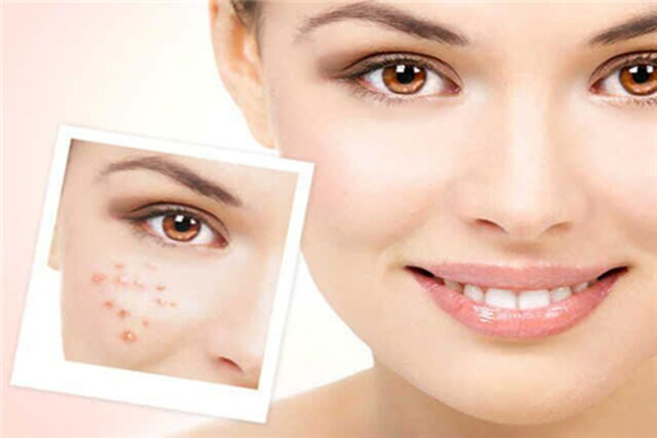 痘痘的日常預(yù)防 各種痘痘形成的原因 痘痘的日常預(yù)防 各種痘痘形成的原因