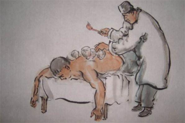 拔罐減肥是天天拔嗎 拔罐減肥多久拔一次 拔罐減肥是天天拔嗎 拔罐減肥多久拔一次