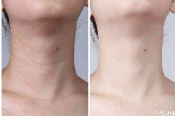 去頸紋的方法有什么 怎么去頸紋比較好 去頸紋的方法有什么 怎么去頸紋比較好