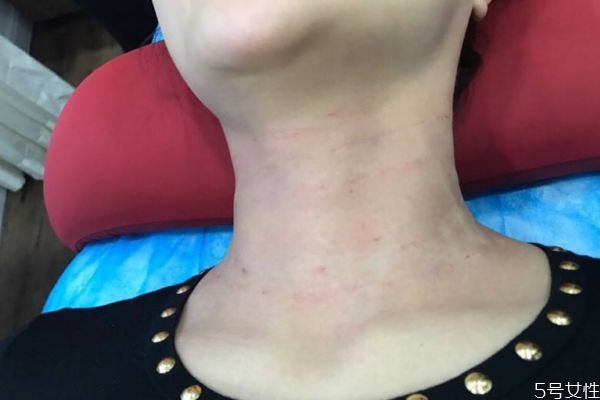 去頸紋的方法有什么 怎么去頸紋比較好 去頸紋的方法有什么 怎么去頸紋比較好